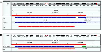 De Novo Large Deletion Leading to Fragile X Syndrome